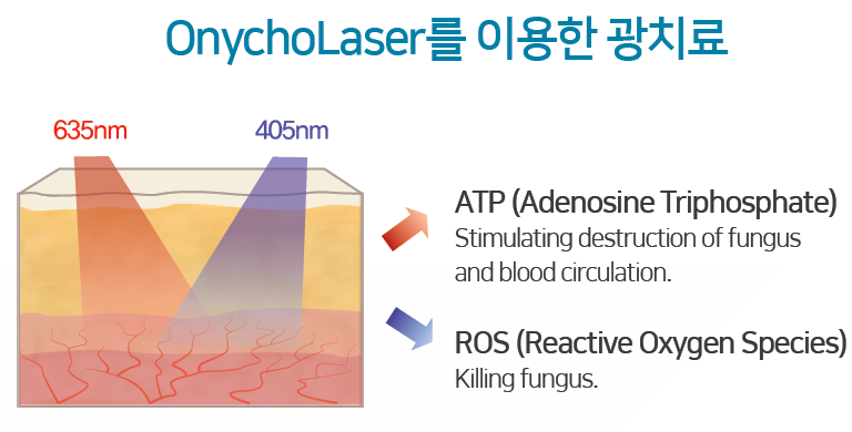 새로운 발톱무좀치료의 시작, 연세봄빛피부과의 오니코레이저 관련 이미지 6