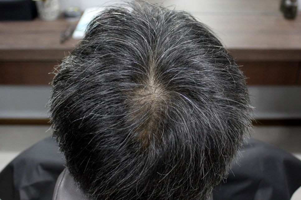 연세봄빛피부과 탈모치료 #5 (남성형탈모, 이마탈모, 정수리탈모) 관련 이미지 6