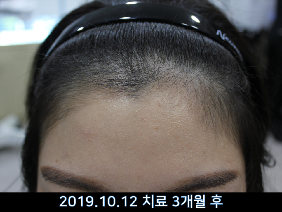 연세봄빛피부과 탈모치료 #38 (여성형탈모, 여성이마탈모) 관련 이미지 2