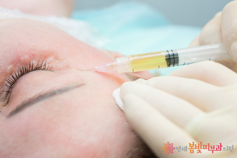 다크써클 없애는법 #5 (다크써클의 치료: 기타 주사 치료, PDRN, 리쥬란 힐러, 플라센텍스, 혈소판 풍부 인자, PRP) 관련 이미지 4