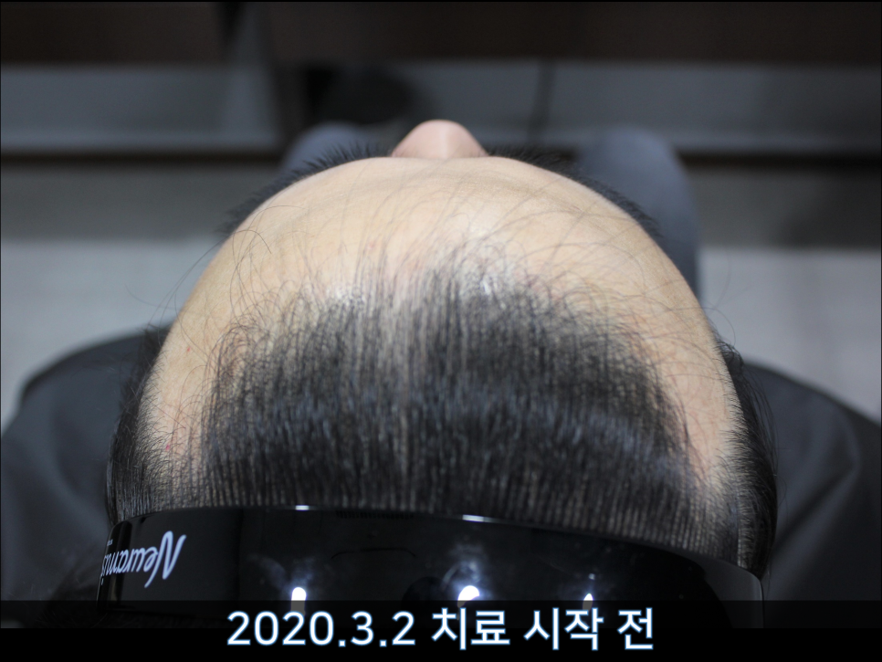 연세봄빛피부과 탈모치료 #44 (남성형탈모,M형+C형탈모) 관련 이미지 5