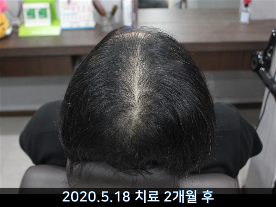 연세봄빛피부과 탈모치료 #44 (남성형탈모,M형+C형탈모) 관련 이미지 3