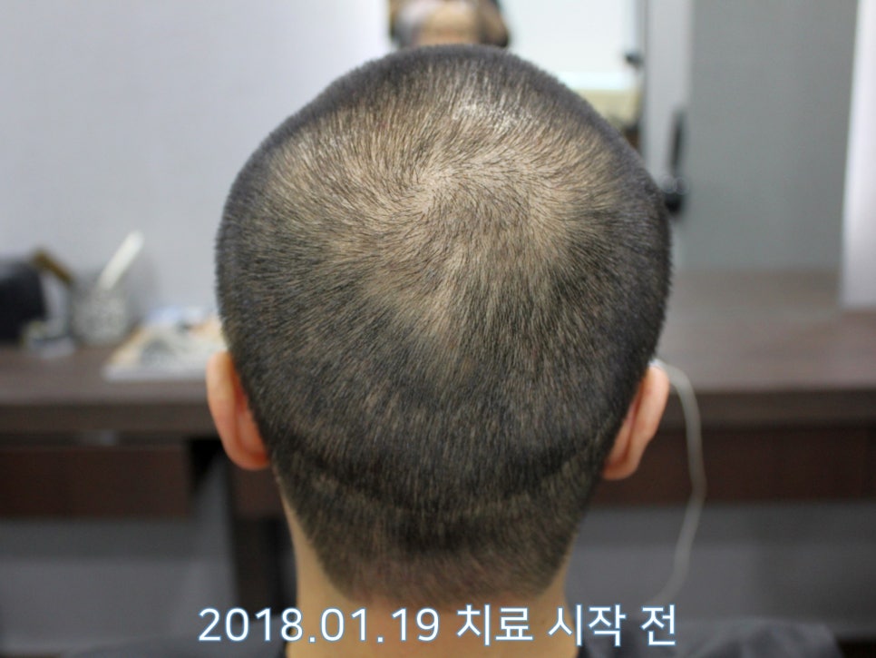 연세봄빛피부과 탈모치료 #17 (남성형탈모, 정수리탈모, F유형) 관련 이미지 5