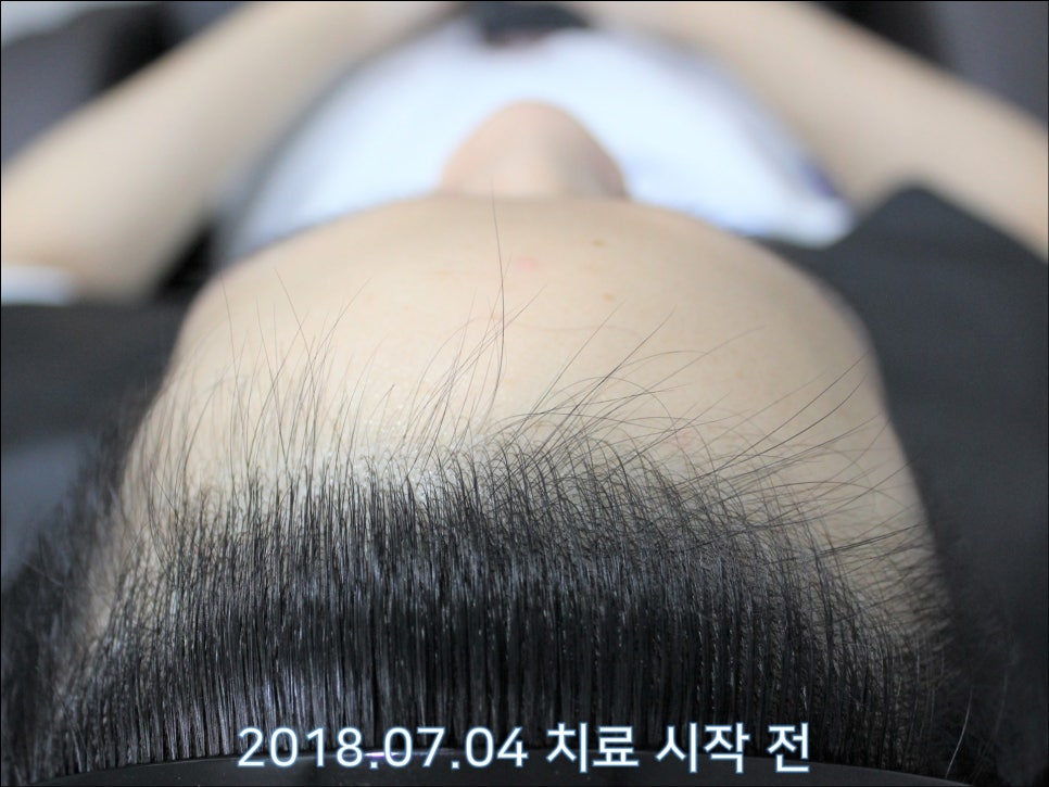 연세봄빛피부과 탈모치료 #26 (남성형탈모, 이마탈모) 관련 이미지 3