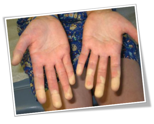 혈액순환 장애로 생기는 그물 울혈반과 레이노드증후군 관련 이미지 2