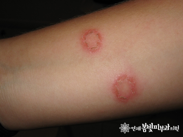 길냥이 엄마들에게 찾아오는 불청객, 링웜! 관련 이미지 1