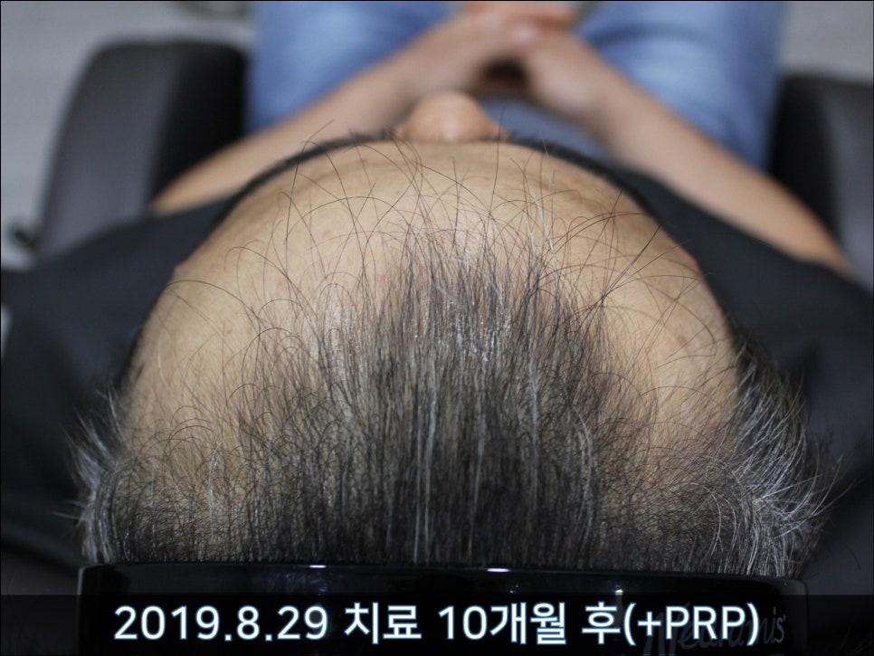 연세봄빛피부과 탈모치료 #30 (남성형탈모, 이마탈모, 정수리탈모) 관련 이미지 8