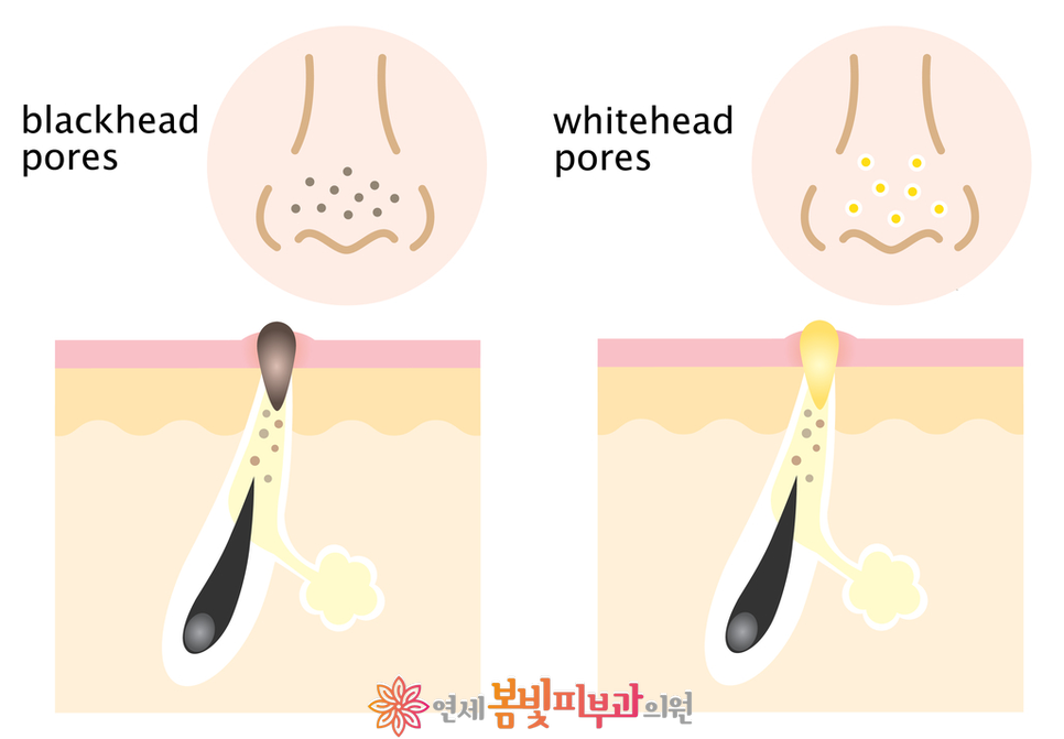 모공줄이는 방법 #1 (모공이 생기는 원인, 분류, 블랙헤드, 화이트헤드, 아쿠아필, 제네시스 레이저) 관련 이미지 3