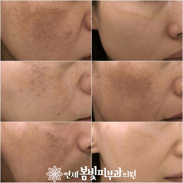 기미는 도대체 왜 생길까요? 관련 이미지 4