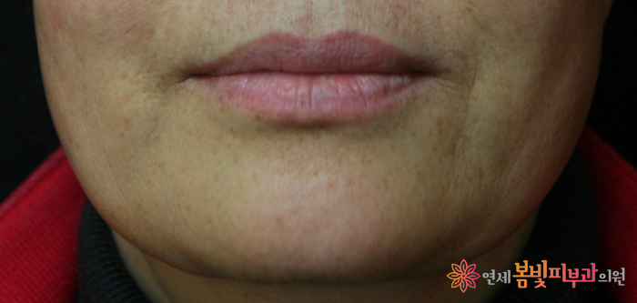 보톡스 바르게 알기 #3 (보톡스 맞고 예뻐지기, 보톡스 시술이 가능한 부위, 이마 주름, 미간 주름, 눈가 주름, 눈밑 주름, 콧잔등 주름, 입가 주름, 사각턱, 종아리, 윤곽술 관련 이미지 6