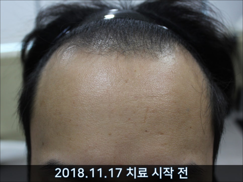 연세봄빛피부과 탈모치료 #33 (남성형탈모, 이마탈모, 정수리탈모, 가족력없음) 관련 이미지 2