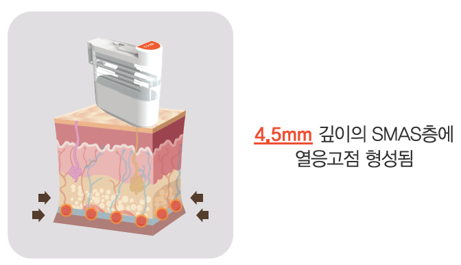리프팅 레이저의 새로운 강자, 울트라스킨 플러스 도입 관련 이미지 6