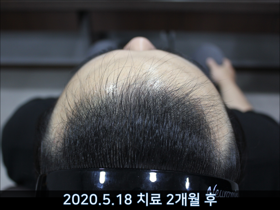 연세봄빛피부과 탈모치료 #44 (남성형탈모,M형+C형탈모) 관련 이미지 6