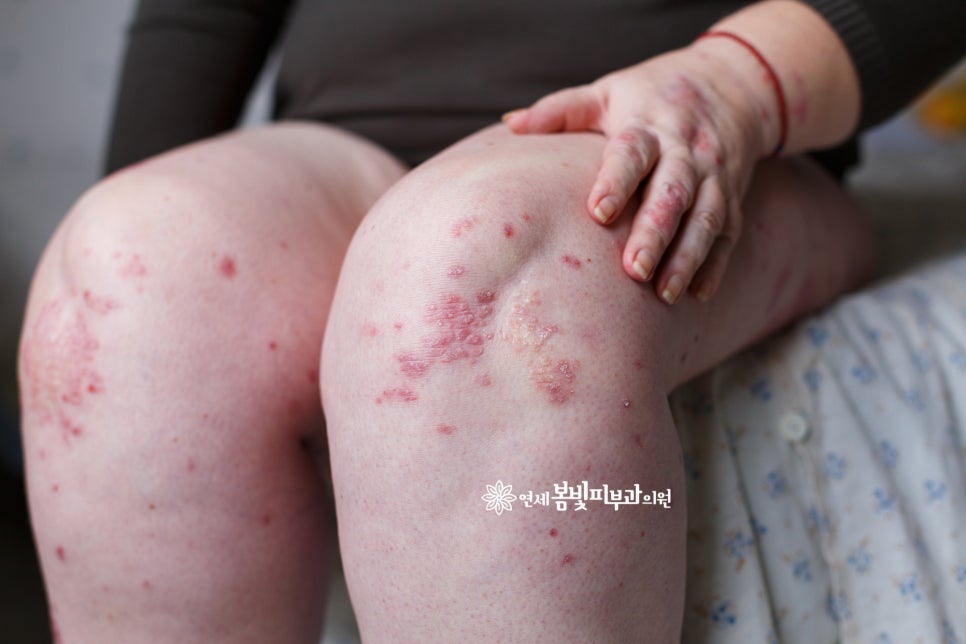 듀피젠트 급여화, 아토피 환자의 새로운 희망 관련 이미지 1