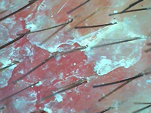 샴푸로 탈모가 좋아질까요? 관련 이미지 1