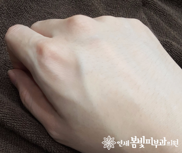 여드름, 지성 피부에도 문제없는 ASF 피지컬 선블럭 관련 이미지 10