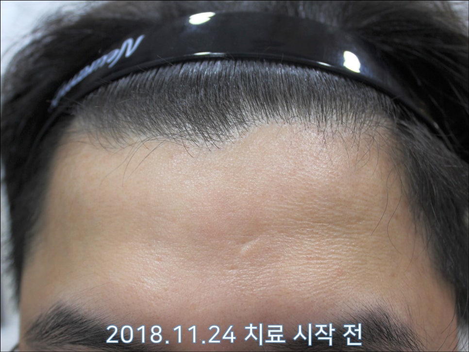 연세봄빛피부과 탈모치료 #28 (남성형탈모, 정수리탈모) 관련 이미지 4