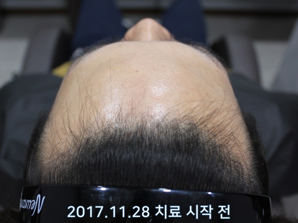 연세봄빛피부과 탈모치료 #7 (남성형탈모, 이마탈모, 정수리탈모) 관련 이미지 1