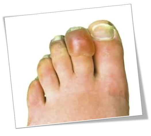 동상과 동창, 겨울의 불청객 #1 (동상) 관련 이미지 2