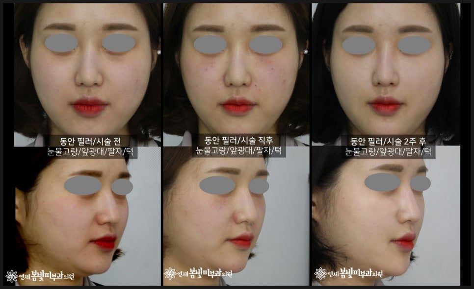동안필러 치료 예시 #3,4 (앞광대필러, 팔자필러, 눈물도랑필러, 볼꺼짐필러) 관련 이미지 2