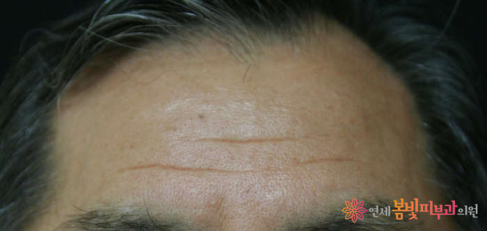 보톡스 바르게 알기 #3 (보톡스 맞고 예뻐지기, 보톡스 시술이 가능한 부위, 이마 주름, 미간 주름, 눈가 주름, 눈밑 주름, 콧잔등 주름, 입가 주름, 사각턱, 종아리, 윤곽술 관련 이미지 2