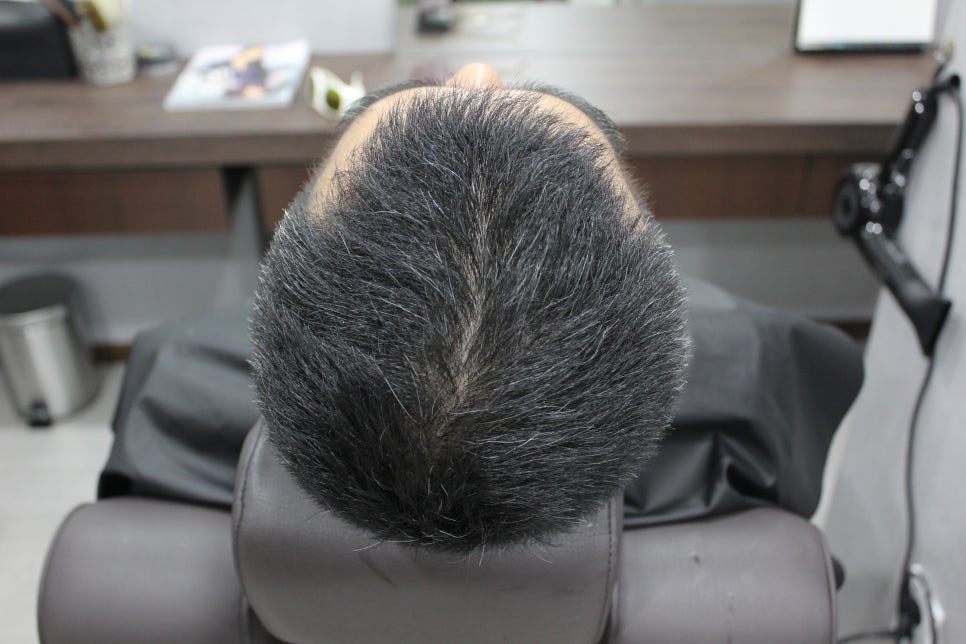 연세봄빛피부과 탈모치료 #4 (남성형탈모, 이마탈모, 정수리탈모) 관련 이미지 4