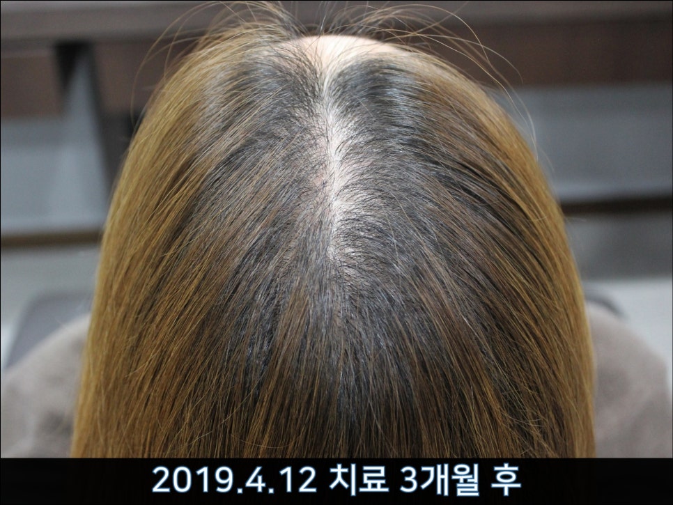 연세봄빛피부과 탈모치료 #37 (여성형탈모, 정수리탈모) 관련 이미지 2