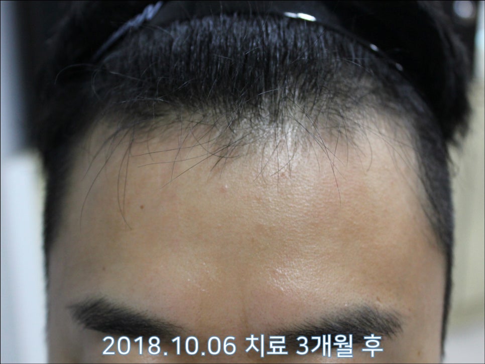연세봄빛피부과 탈모치료 #27 (남성형탈모, 이마탈모 정수리탈모) 관련 이미지 2
