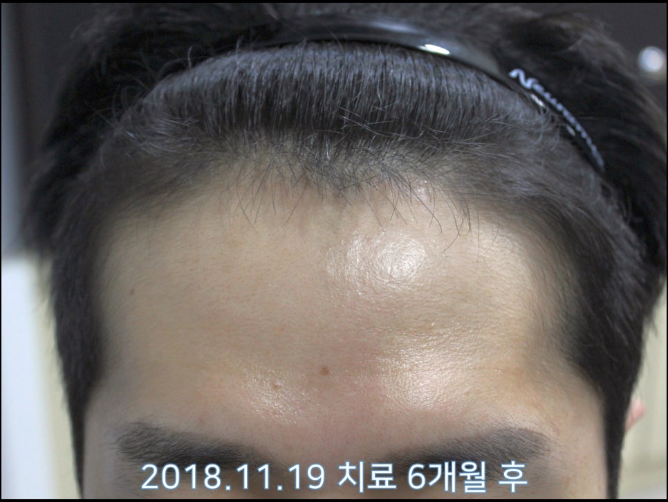 연세봄빛피부과 탈모치료 #22 (남성형탈모, 이마탈모) 관련 이미지 4