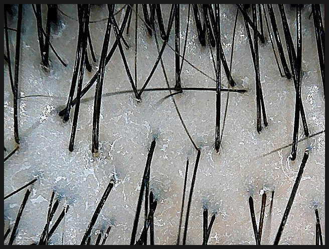 연세봄빛피부과 탈모치료 #2 (남성형탈모, 이마탈모, 정수리탈모) 관련 이미지 4