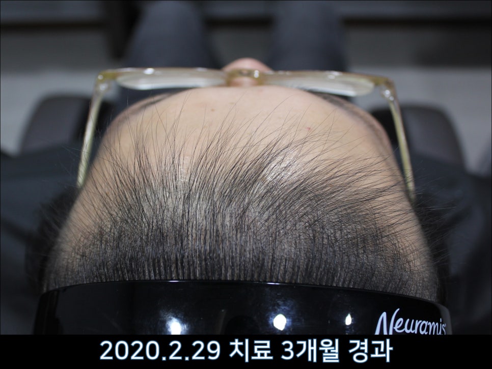 연세봄빛피부과 탈모치료 #43 (정수리탈모, F형 탈모) 관련 이미지 5