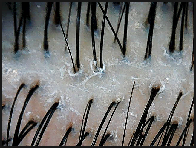 연세봄빛피부과 탈모치료 #2 (남성형탈모, 이마탈모, 정수리탈모) 관련 이미지 6