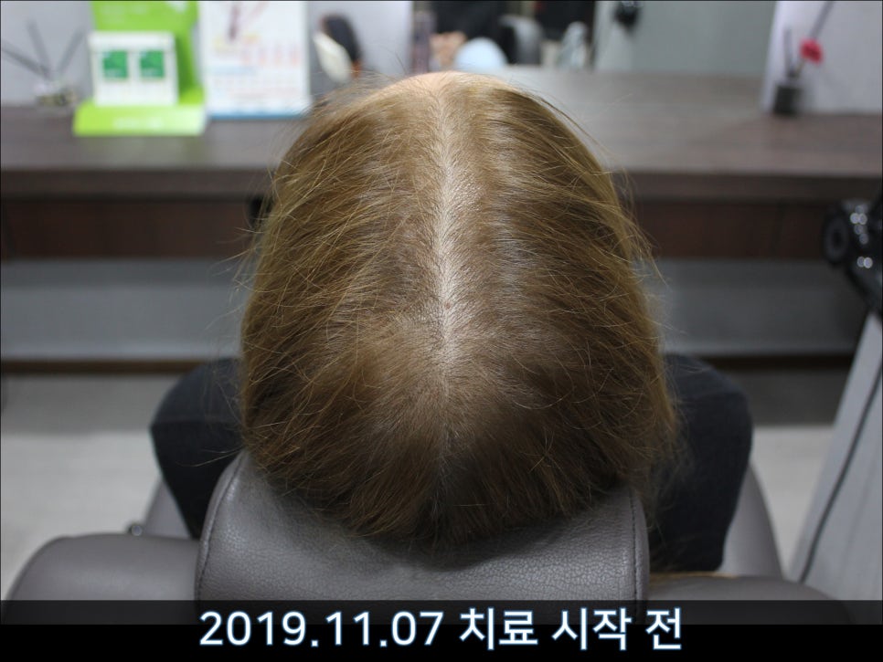 연세봄빛피부과 탈모치료 #40 (여성형탈모, 외국인의 경우) 관련 이미지 1