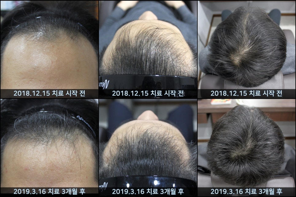 연세봄빛피부과 탈모치료 #36 (남성형탈모, 이마탈모, 3개월) 관련 이미지 7