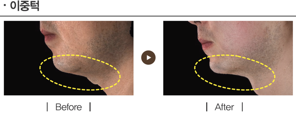 리프팅 레이저의 새로운 강자, 울트라스킨 플러스 도입 관련 이미지 8