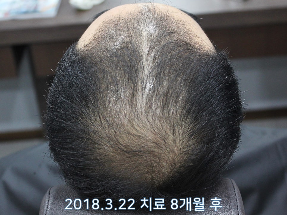 연세봄빛피부과 탈모치료 #9 (남성형탈모, 이마탈모, 정수리탈모) 관련 이미지 6