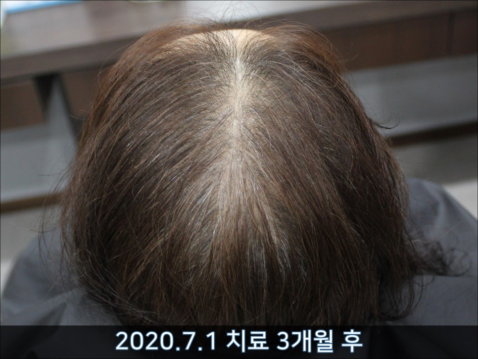 연세봄빛피부과 탈모치료 #45 (AI를 이용한 탈모 치료 성과 분석) 관련 이미지 4