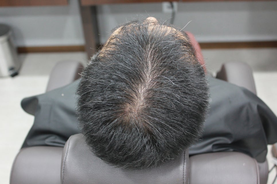 연세봄빛피부과 탈모치료 #4 (남성형탈모, 이마탈모, 정수리탈모) 관련 이미지 3