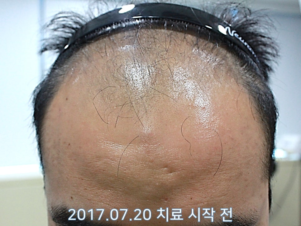 연세봄빛피부과 탈모치료 #9 (남성형탈모, 이마탈모, 정수리탈모) 관련 이미지 1