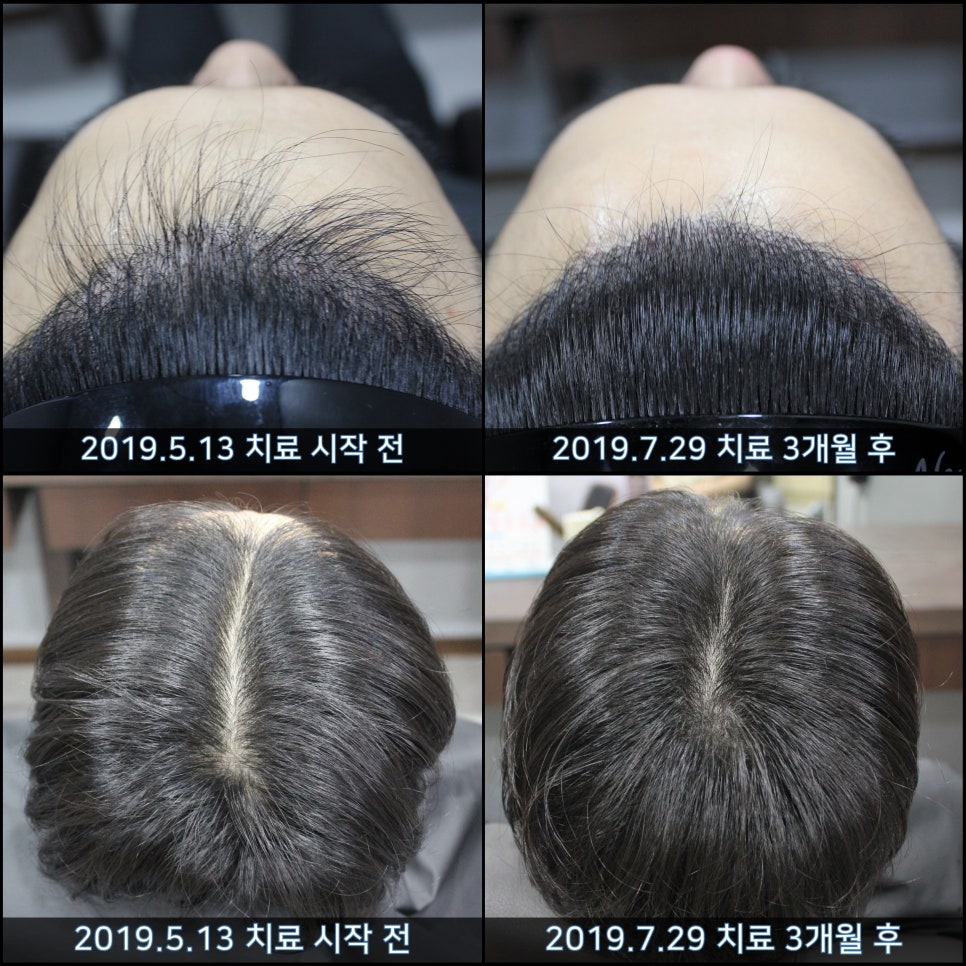 연세봄빛피부과 탈모치료 #34 (남성형탈모, 모발이식 후 치료) 관련 이미지 5