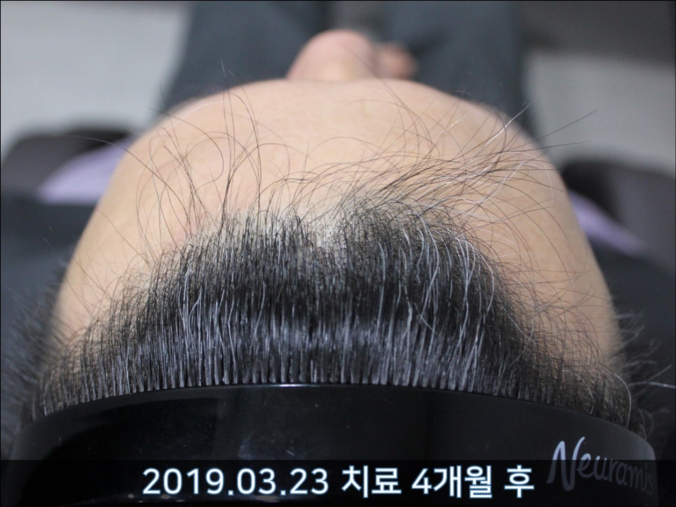 연세봄빛피부과 탈모치료 #31 (탈모와 모자 착용, 남성형탈모, 이마탈모, 정수리탈모) 관련 이미지 4