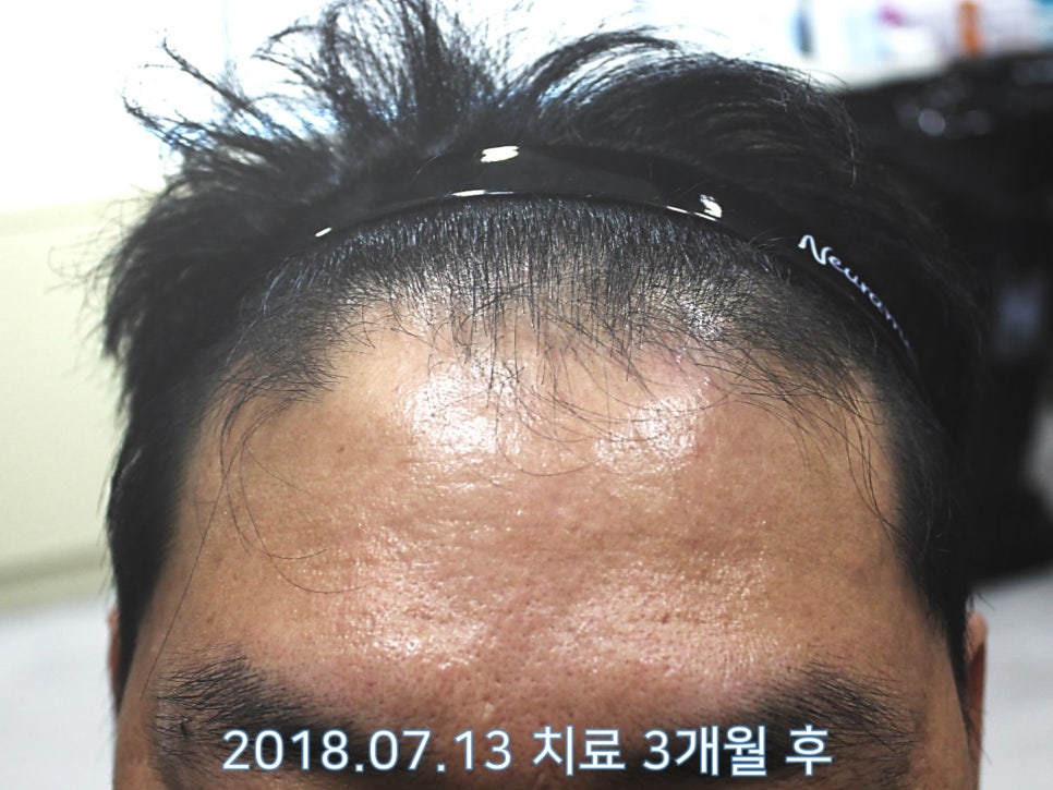 연세봄빛피부과 탈모치료 #20 (남성형탈모, 정수리탈모, 헤어스타일) 관련 이미지 4