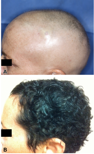 원형탈모, 머리숱많아지는법 #4 (신약-바이토린, 젤잔즈, 자가혈 PRP) 관련 이미지 2