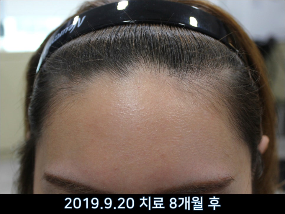 연세봄빛피부과 탈모치료 #37 (여성형탈모, 정수리탈모) 관련 이미지 9