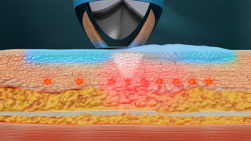 CoolSoniq: Keep Skin Cool, Deliver Energy Deeply image 2