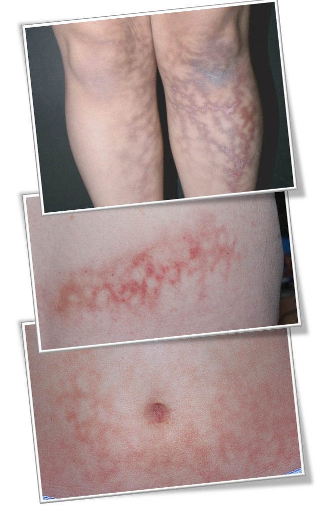 겨울철 난방기 사용 주의 #2 열성홍반 (온풍기, 전기히터, 전기난로, 라디에이터, 발난로, 핫팩, 손난로) 관련 이미지 2