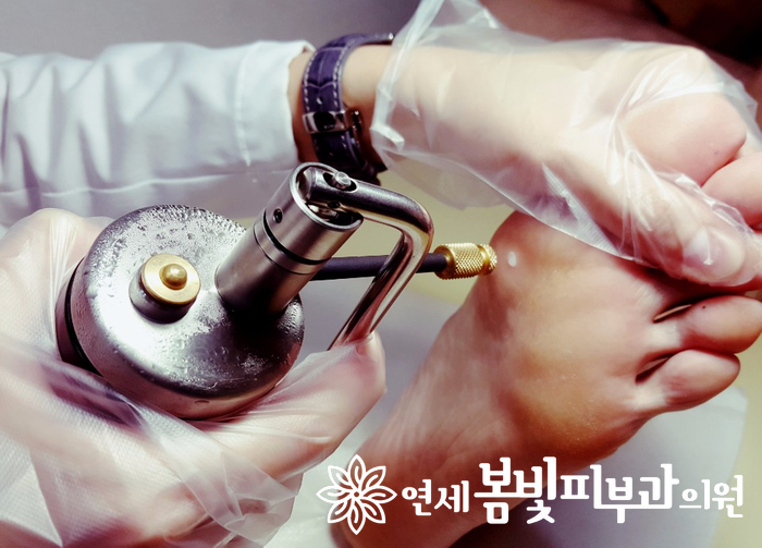 티눈, 사마귀 저리가라~ 냉동치료란? 관련 이미지 4