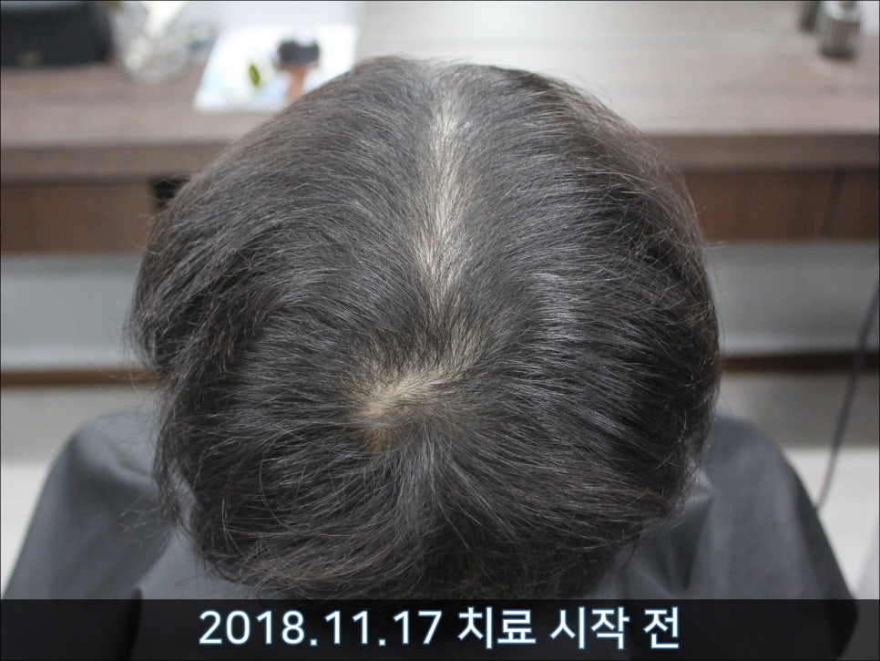 연세봄빛피부과 탈모치료 #33 (남성형탈모, 이마탈모, 정수리탈모, 가족력없음) 관련 이미지 7