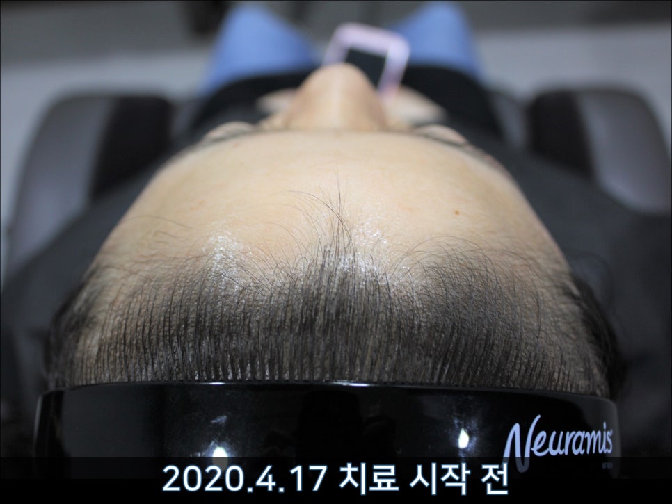 연세봄빛피부과 탈모치료 #45 (AI를 이용한 탈모 치료 성과 분석) 관련 이미지 3