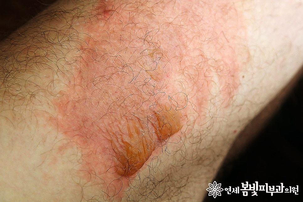 겨울철 난방기 사용 주의 #1 저온화상 (온수매트, 전기장판, 전기매트, 전기요) 관련 이미지 2